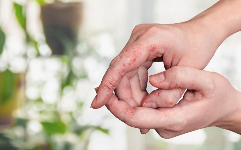 delgocitinib乳膏治疗慢性手部湿疹两项3期临床数据已发表在《柳叶刀》上