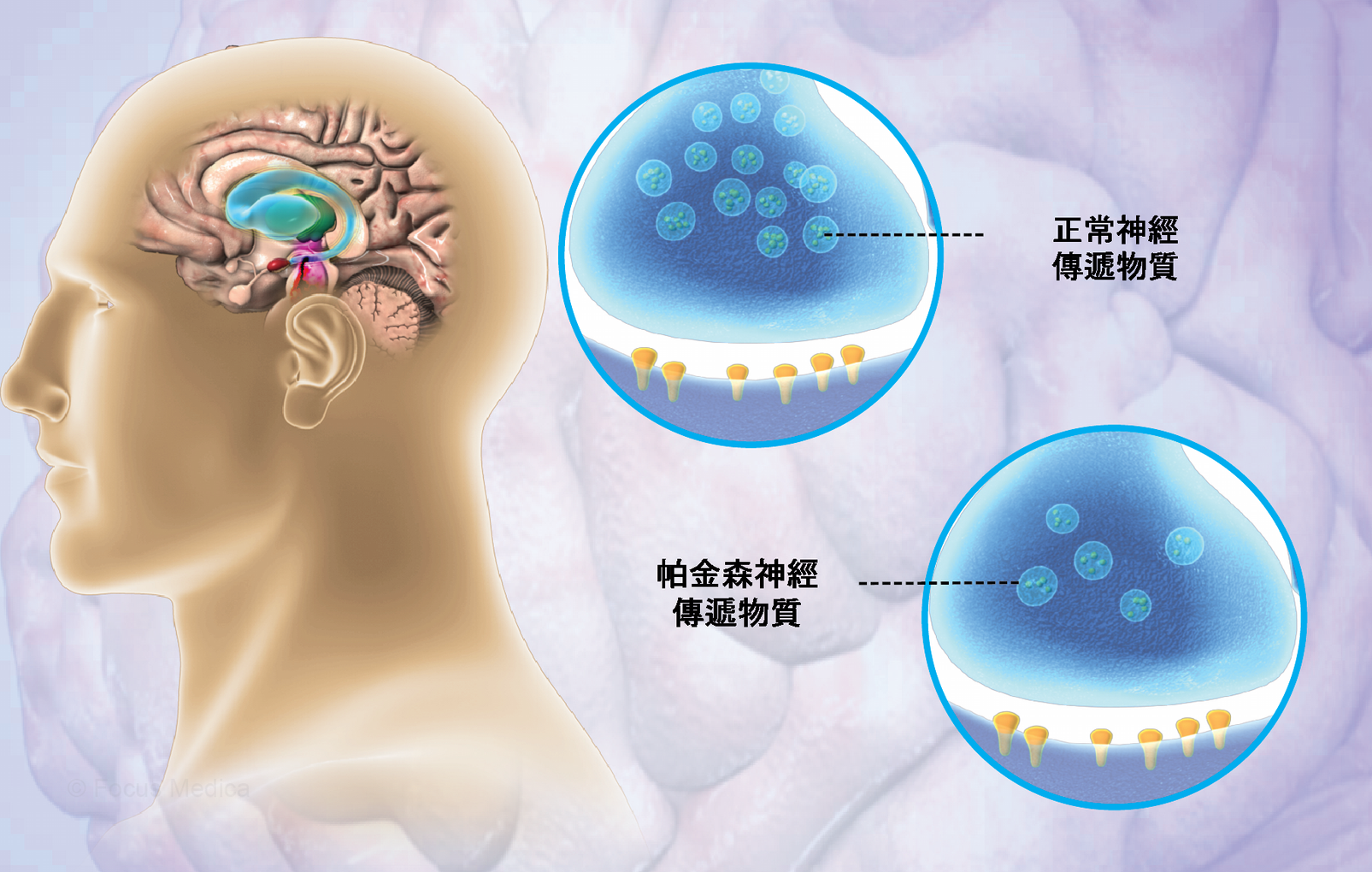 灵活剂量试验显示Tavapadon对早期帕金森病有益_香港济民药业