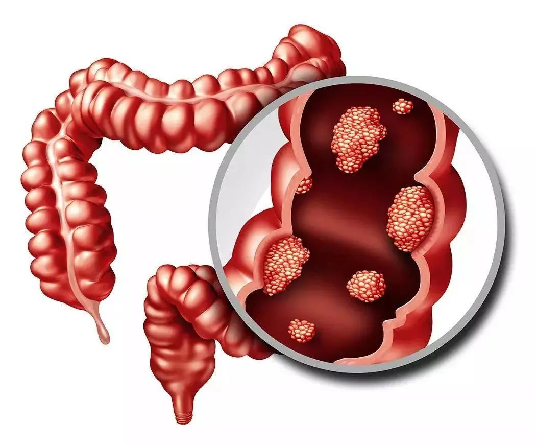 β-连环蛋白拮抗剂ST316被指定为治疗家族性腺瘤性息肉病的孤儿药_香港济民药业