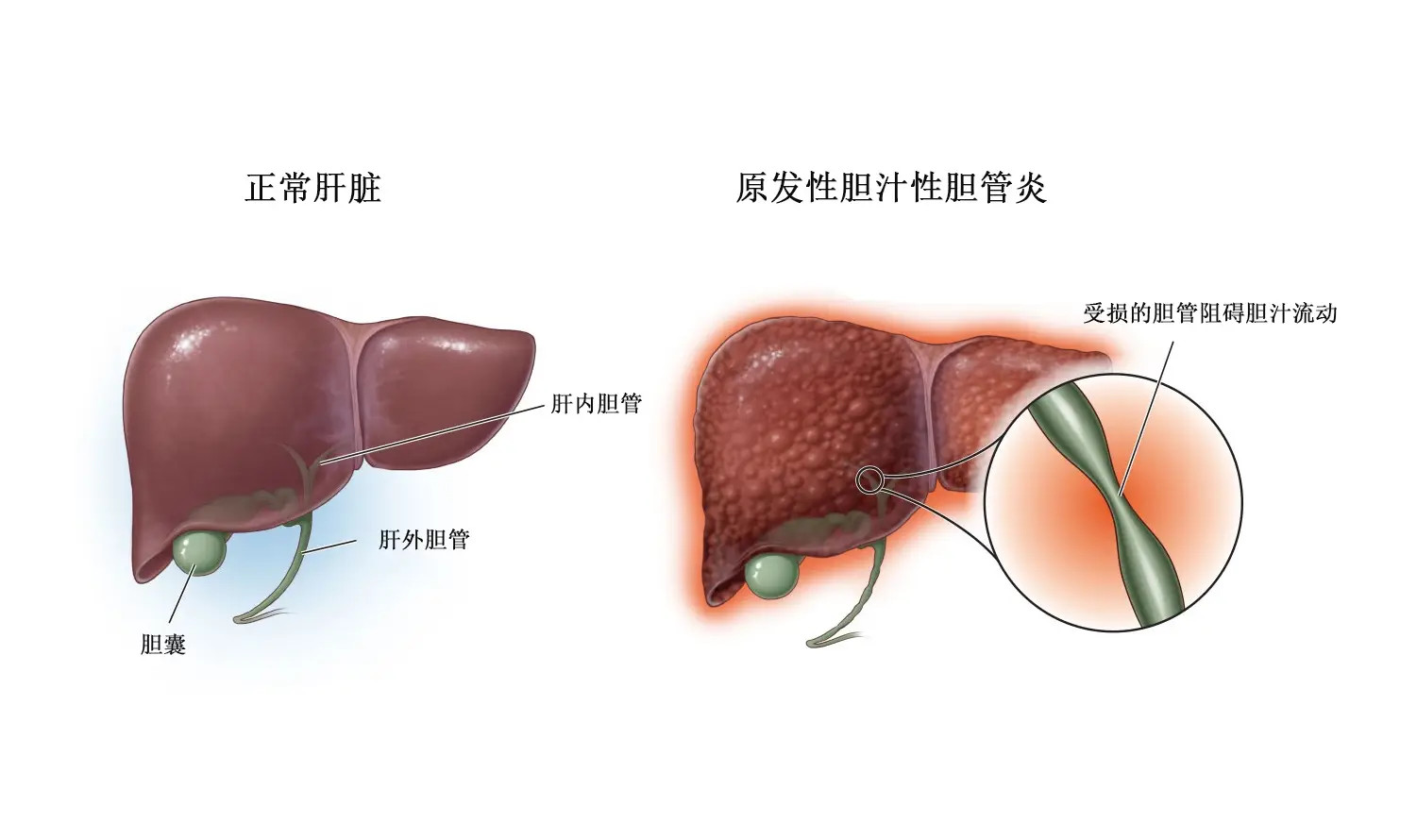 Livdelzi在治疗原发性胆汁性胆管炎方面表现出持续的疗效和长期的安全性_香港济民药业