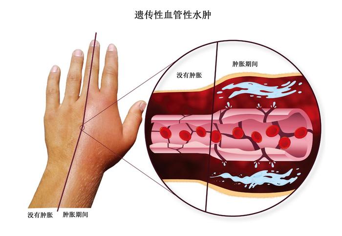 遗传性血管性水肿新药ANDEMBRY(garadacimab)在日本获批_香港济民药业