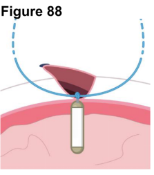 Encelto(revakinagene taroretcel-lwey)中文说明书-价格-适应症-不良反应及注意事项_香港济民药业